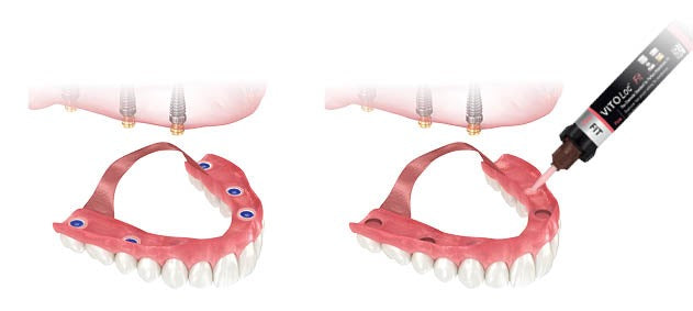 VITO Loc Fit — Attachment Retention Resin (Pink 5ml Automix Syringe)