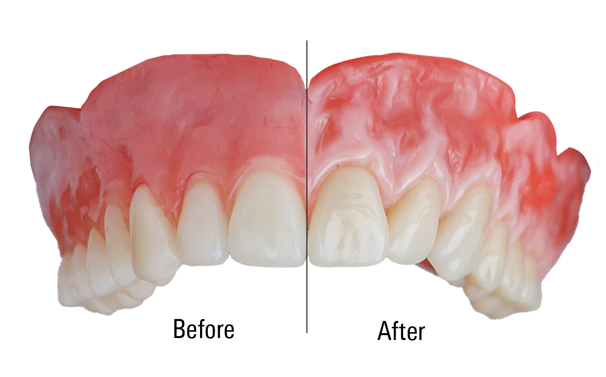 VITOGUM GEL Light-Cured Gel Composite System for Reproducing Natural-Looking Gingiva