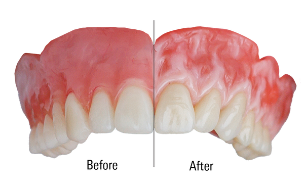 VITOGUM GEL Light-Cured Gel Composite System for Reproducing Natural-Looking Gingiva