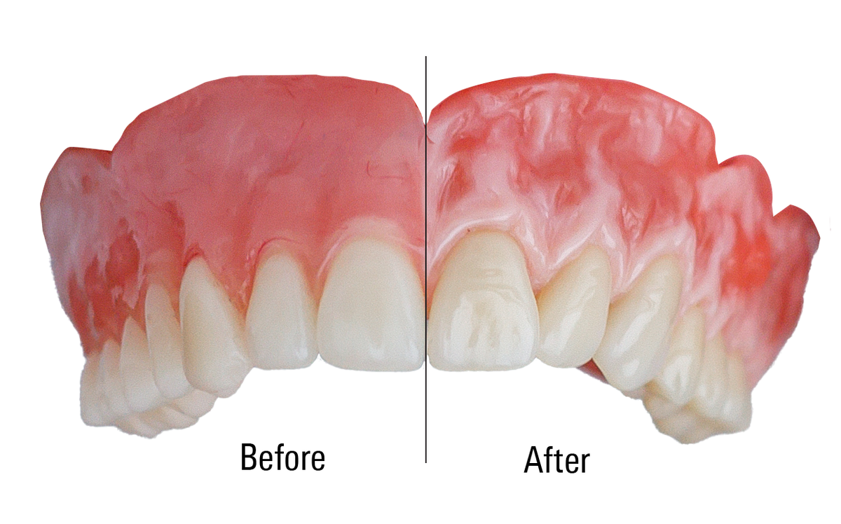 VITOGum GEL — Light-Cured Gum Composite Refill (Red 3g Syringe)